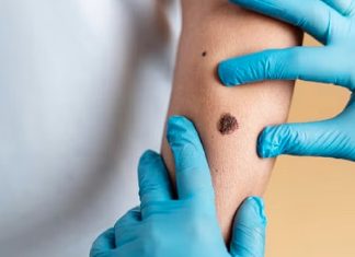 भारतमा पनि एमपक्सको शंकास्पद घटना, विरामीलाई आइसोलेट गरियो